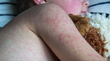 Measles Confirmed in Lubbock Child, Officials Say