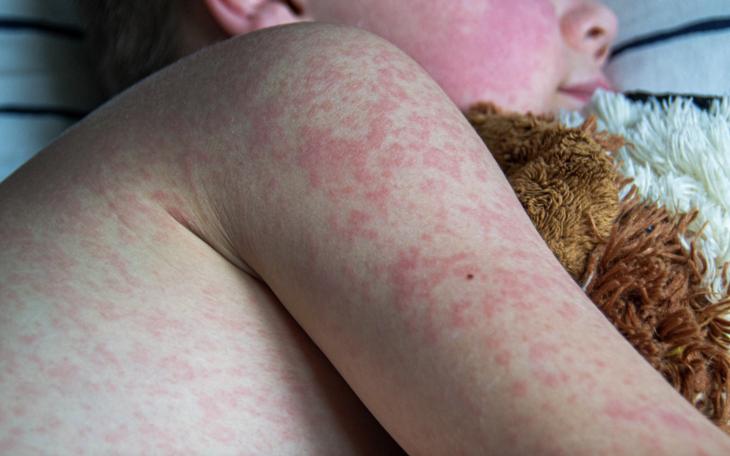 Measles Confirmed in Lubbock Child, Officials Say