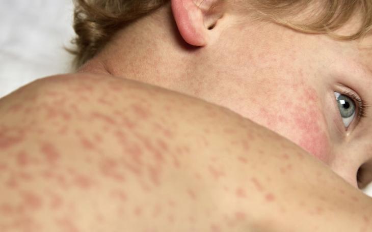 90 Measles Cases Reported in South Plains Outbreak